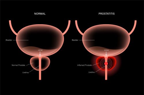 Home Remedy Destroys Prostatitis